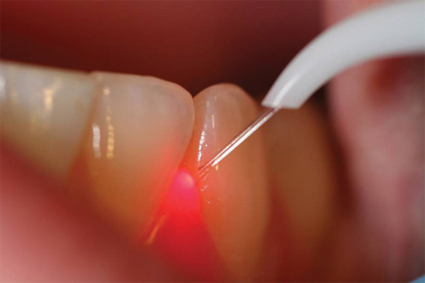 Il laser dentale è una tecnologia versatile che offre numerosi benefici in diversi trattamenti odontoiatrici. Grazie alla sua capacità di focalizzare l'energia luminosa in modo preciso, il laser dentale consente interventi chirurgici meno invasivi, riducendo il trauma dei tessuti, il sanguinamento e il gonfiore post-operatorio. È anche efficace nel trattamento di gengiviti, riduzione del batterio presente nelle tasche parodontali e nella terapia canalare. Il laser dentale offre risultati più rapidi, meno disagio e tempi di recupero più brevi per i pazienti.